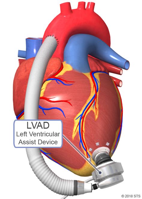 lv das
